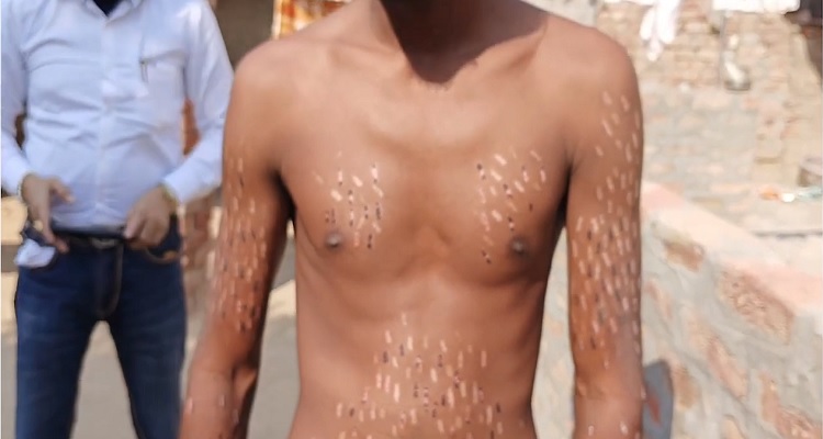 सांप के काटने से युवक का शरीर हो गया सांप जैसा, डॉक्टर भी हैरान